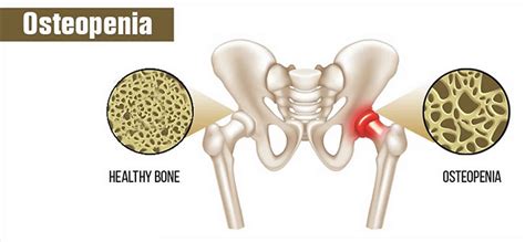 Osteopenia definition, causes, prevention, diet, symptoms, diagnosis ...