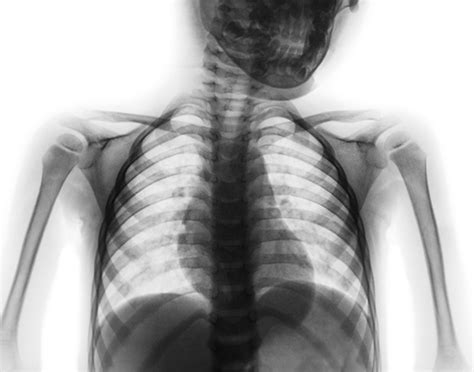 Thoracic spine x-ray