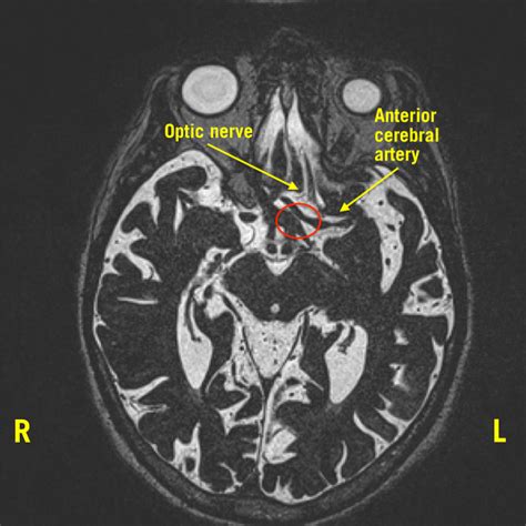 Neurovascular Compression of the Optic Nerve Causing Peripheral Vision ...