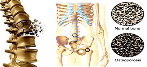 Air pollution causes weak bones, fractures