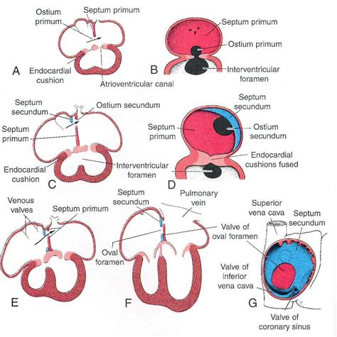 Types of ASDs | Cardiac sonography, Echocardiogram, Atrial septal defect