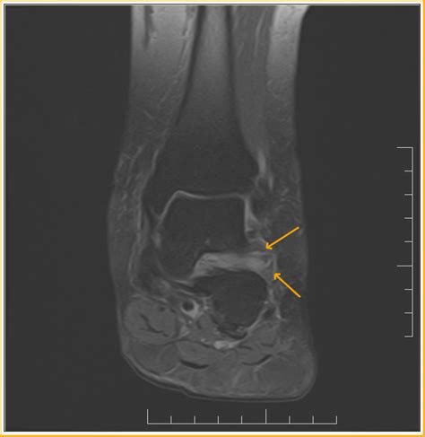 Sinus Tarsi Syndrome : MRI - Sumer's Radiology Blog