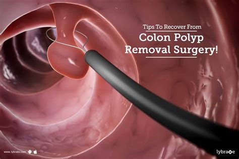 Tips To Recover From Colon Polyp Removal Surgery! - By Dr. Avaneesh ...