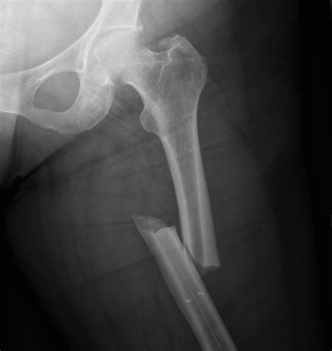 Femoral Shaft Fractures | The Bone School