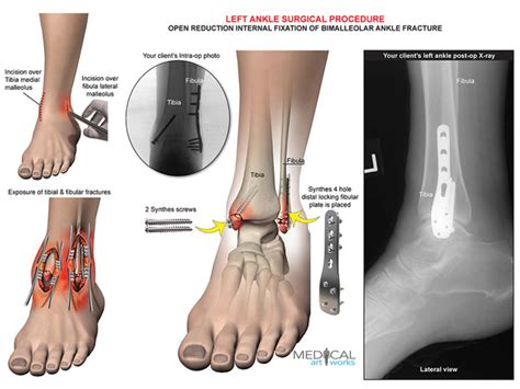 Left ankle and tibia bimalleolar fracture -ORIF — Medical Art Works