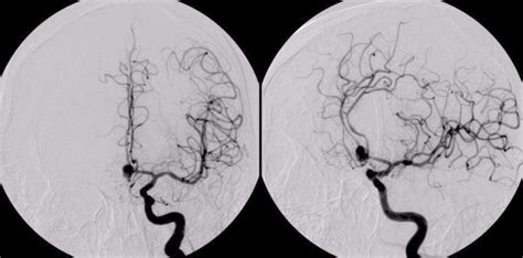 Subarachnoid HemorrhageAcomm6b