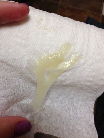 mucus plug or discharge? (photo) - Page 2 | BabyCenter