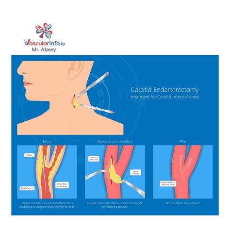 Carotid Endarterectomy - Vascular Info