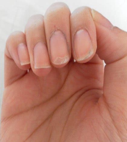 Causes Of Peeling Nails – Finesse Corner