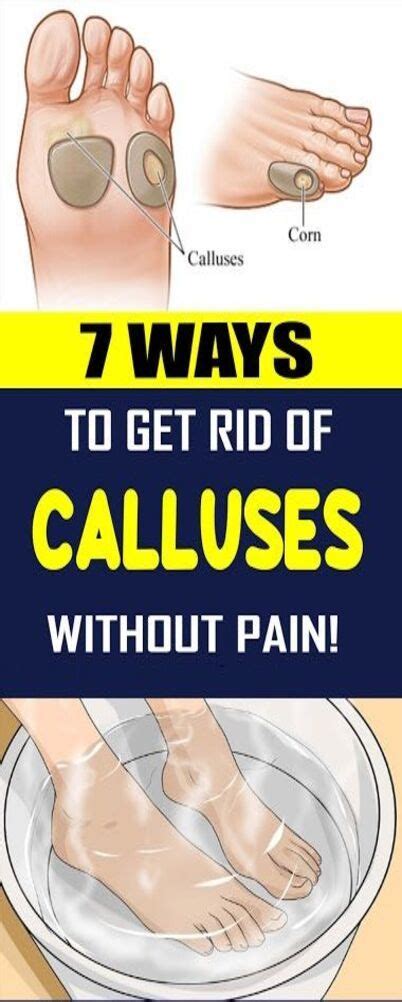 7 Ways To Get Rid Of Calluses Without Pain - wellness days