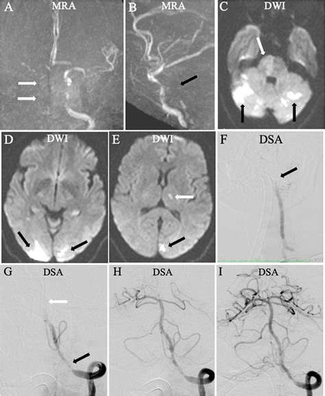 Frontiers | Selection of patients with acute vertebrobasilar artery ...