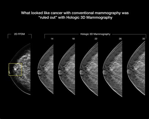 3D Mammography