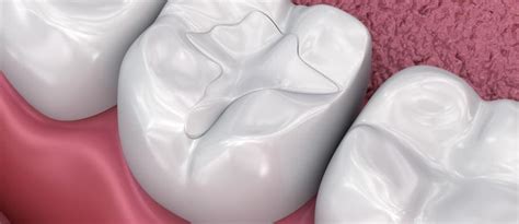 Glass Ionomer: An Overview of a Versatile Dental Material