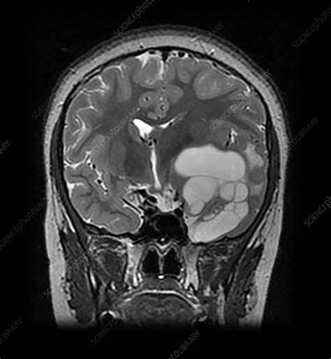 Pleomorphic Xanthoastrocytoma MR - Stock Image - C043/3132 - Science ...