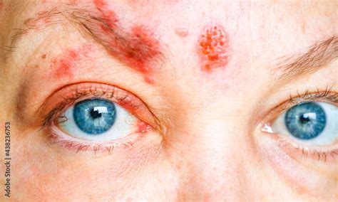 Shingles on Face: Symptoms and Treatment Guide - NetLookFor.com