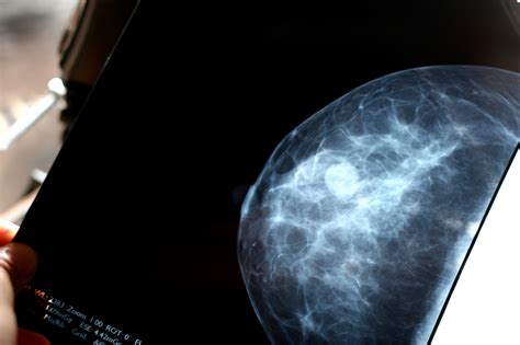 More Mammograms May Not Always Mean Fewer Cancer Deaths : Shots ...