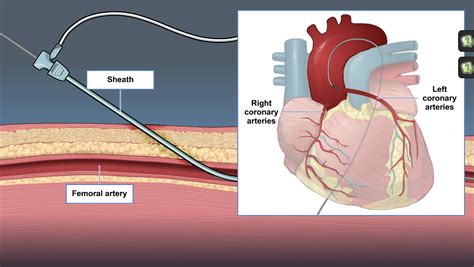 Cardiac Catheterization