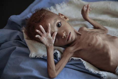 Groups: Both sides used starvation as tool in Yemen war | AP News