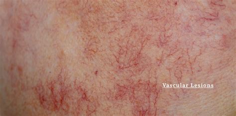 Vascular Skin Lesions