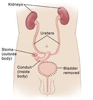 Ileal Conduit