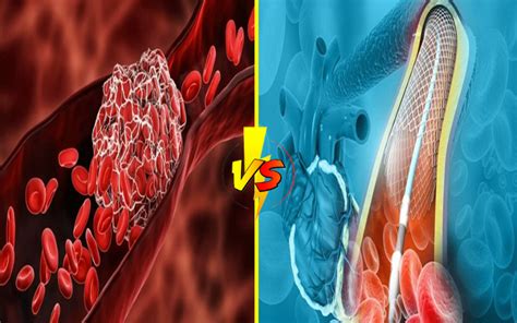 Top 9 Differences Between Stent Thrombosis and Restenosis