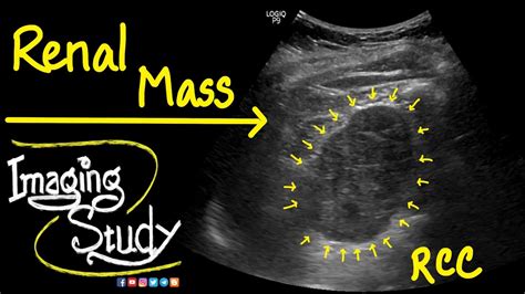 Renal Cell Carcinoma - RCC || Ultrasound || Doppler || Case 41 - YouTube