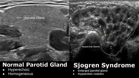 Salivary Glands Ultrasound Normal Vs Abnormal Images | Parotid ...