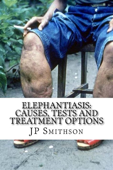 Elephantiasis: Causes, Tests and Treatment Options by JP Smithson ...