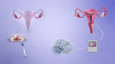 What Are the Different Types of Assisted Reproductive Technology (ART ...