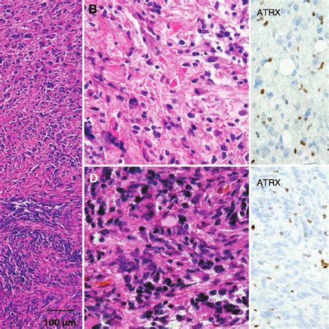 Anaplastic astrocytoma with piloid features (pilocytic astrocytoma with ...