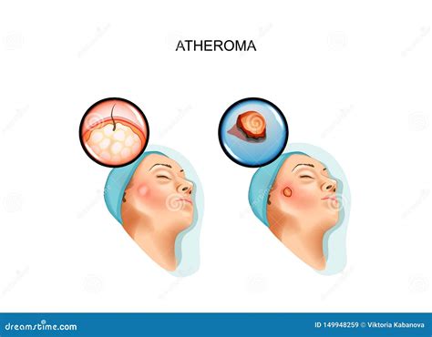 Surgery of Benign Tumors of Atheroma Stock Illustration - Illustration ...