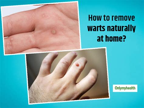 7 Magical Ways To Kiss Warts Away At Home | OnlyMyHealth