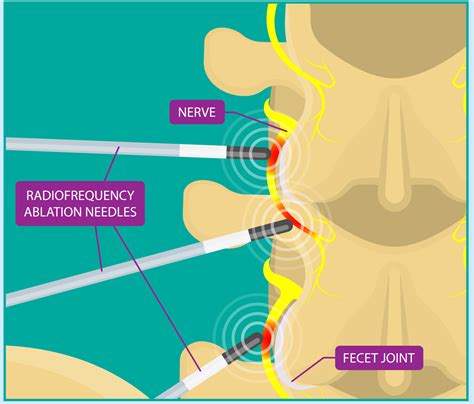 Lumbar Facet Radiofrequency Neurotomy - Shore Spine & Pain