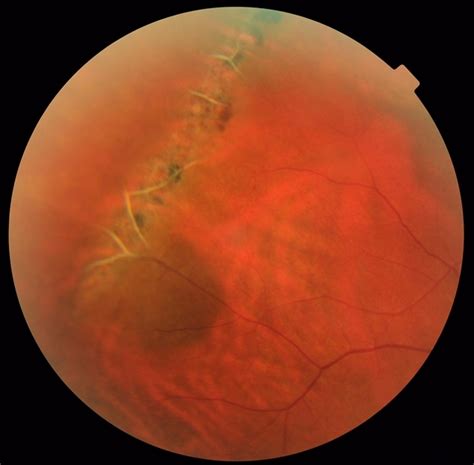 Lattice Degeneration and Choroidal Nevus - Retina Image Bank