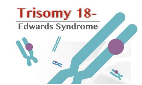 Trisomy 18- Definition, Symptoms, Pictures, Diagnosis And Life Expectancy