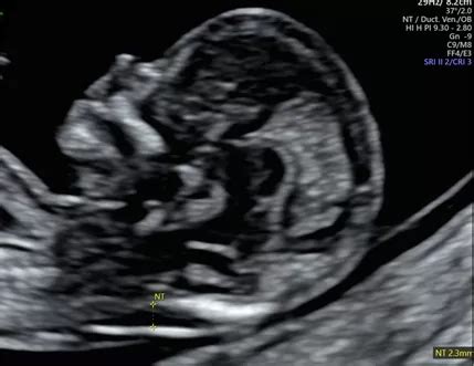 Nuchal Translucency Scan Sydney | Ultrasound Care