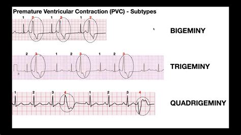 Premature Ventricular Contractions Vs Pac Images And Photos Finder ...