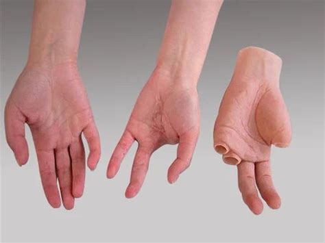 Partial Hand Prosthesis at Rs 60000 | Body Part Silicone Prosthesis in ...