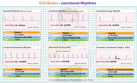 ECG Educator Blog : Junctional Rhythms