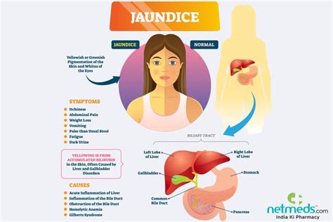 Fatty liver symptoms, Jaundice symptoms, Symptoms