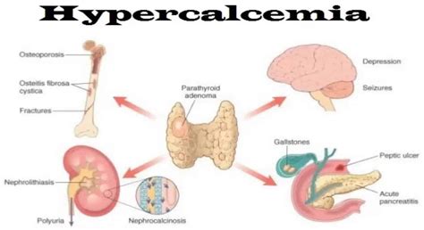 Hypercalcemia - New