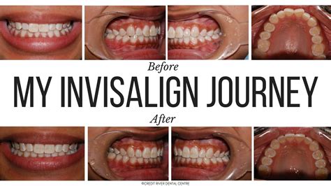 My Invisalign Journey - Credit River Dental