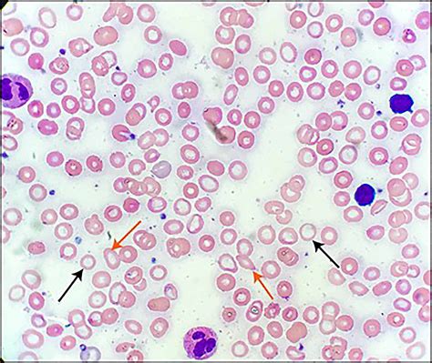 Hemolytic Anemia Peripheral Smear