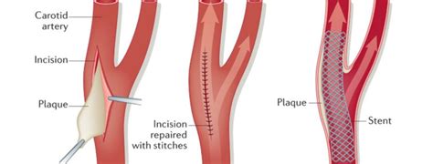 Complications of Carotid Endarterectomy in the Postanesthesia Care Unit