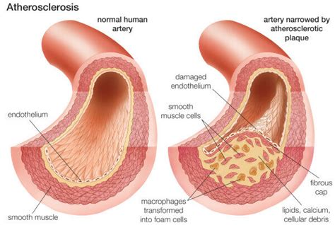 Aterosclerose | Concise Medical Knowledge