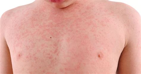 What the meningitis rash looks like and how to identify nine other ...