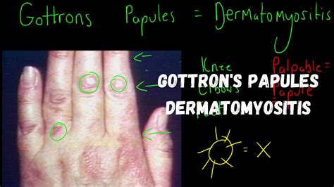 Gottron's Papules - Dermatomyositis - YouTube