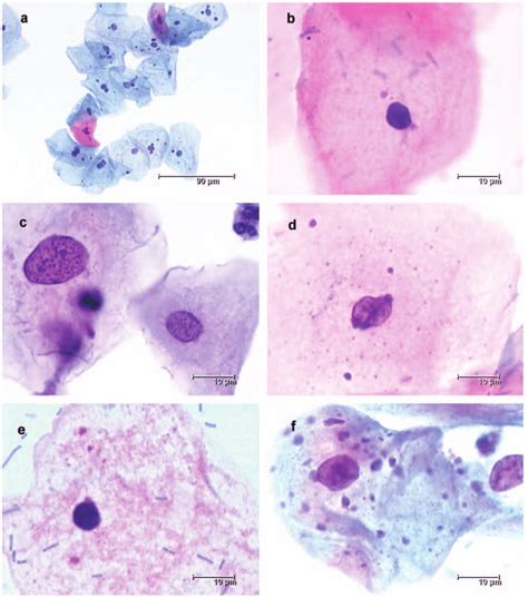 a) Overview of a Pap smear with minimal cytological abnormalities and ...