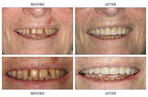 Porcelain Crowns Before And After - Dental News Network