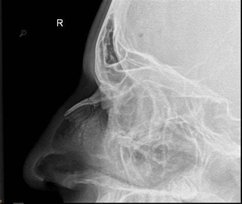 Normal Nasal Bones Xray / normal nasal bone x ray Gallery / There is a ...